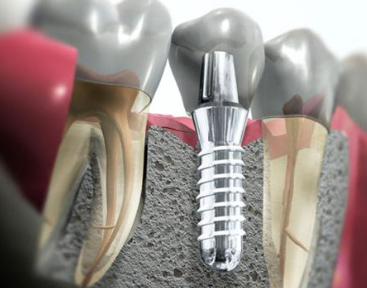 Tirando dúvidas sobre Implantes dentários